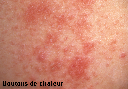 Boutons de chaleur