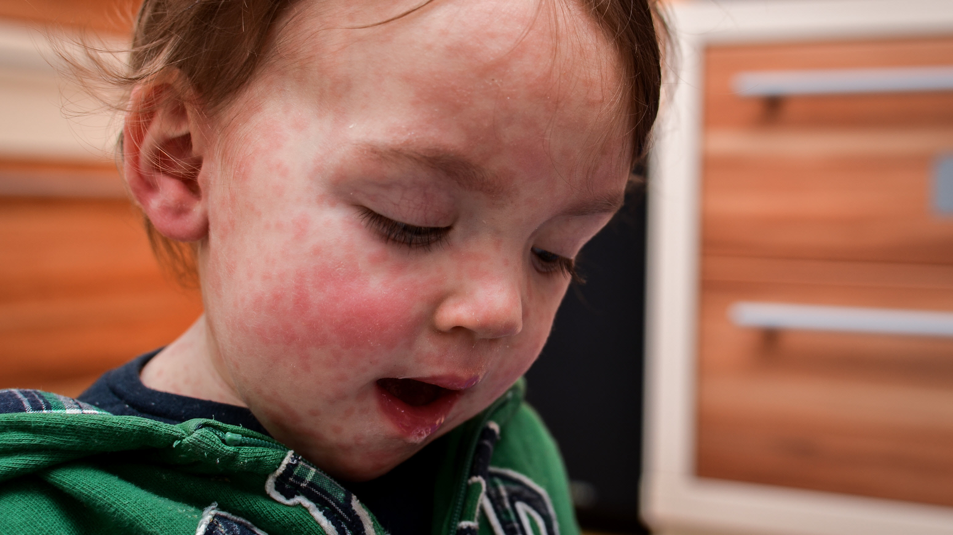 Cas de rougeole: appel à la vaccination pour stopper la progression