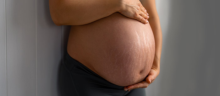 Pregnancy: Stretch marks