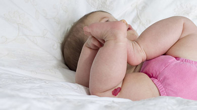 Les taches de naissance